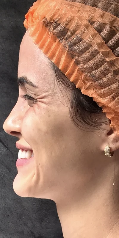 Harmonização orofacial antes – Atually Odontologia 01 Harmonização orofacial antes - Atually Odontologia 01