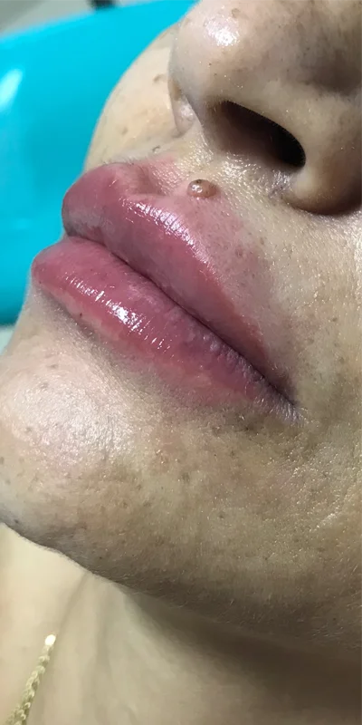 Harmonização orofacial depois – Atually Odontologia 02 Harmonização orofacial depois - Atually Odontologia 02