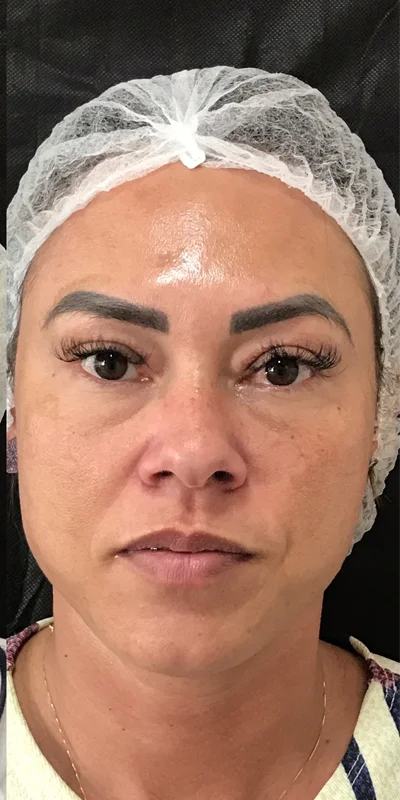 Harmonização orofacial depois – Atually Odontologia 03 Harmonização orofacial depois - Atually Odontologia