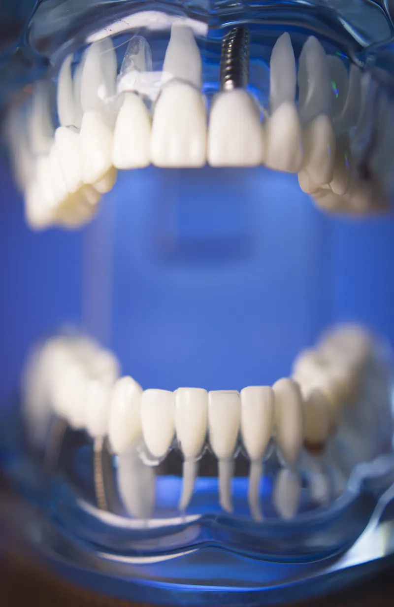 Implante Dentário 1 Implante dentário - Atually Odontologia