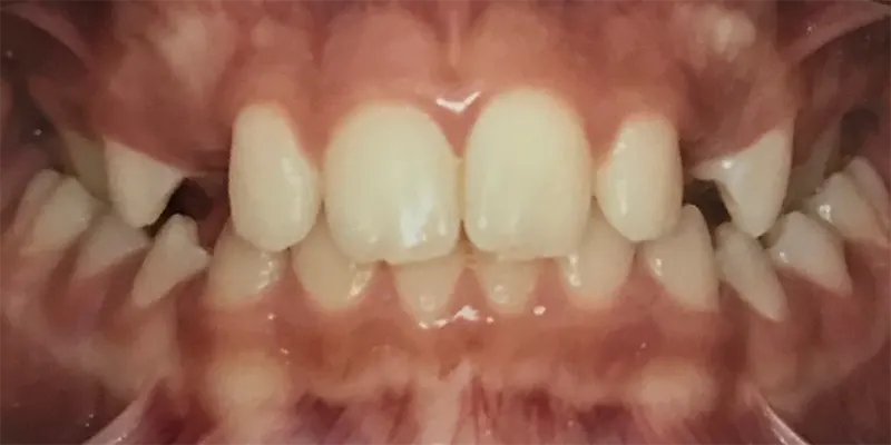 Ortodontia cliente 1 antes – Atually Odontologia – Ortodontia cliente 1 antes - Atually Odontologia -