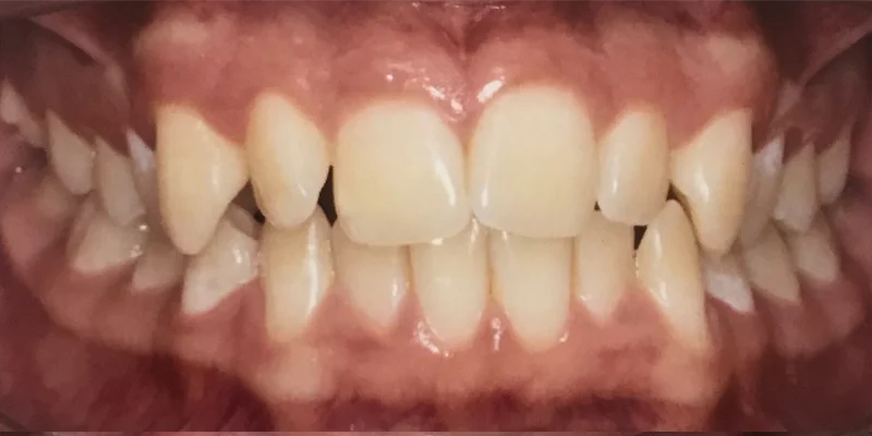 Ortodontia cliente 2 antes – Atually Odontologia – Ortodontia cliente 2 antes - Atually Odontologia -
