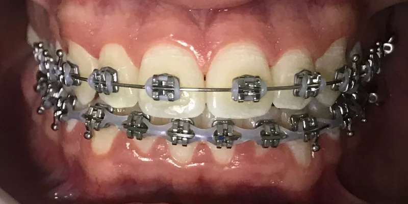 Ortodontia cliente 2 depois – Atually Odontologia – Ortodontia cliente 2 depois - Atually Odontologia -