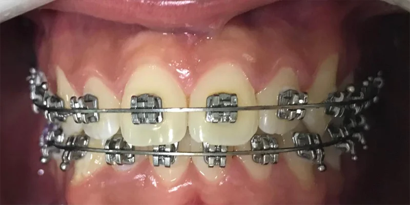 Ortodontia cliente 3 depois – Atually Odontologia – Ortodontia cliente 3 depois - Atually Odontologia -