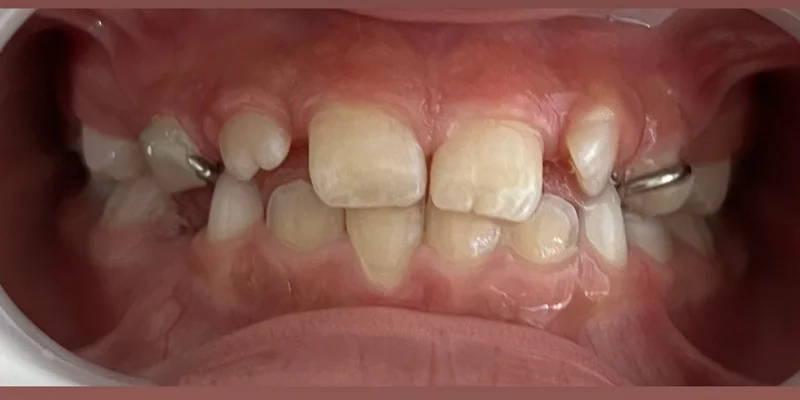Ortopedia Facial dos Maxilares depois – Atually Odontologia – Ortopedia Facial dos Maxilares depois - Atually Odontologia -